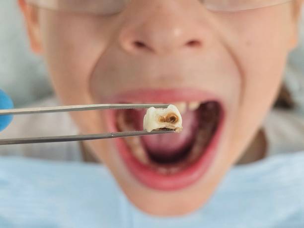 Best Emergency Care for Gum Disease in Stuarts Draft, VA